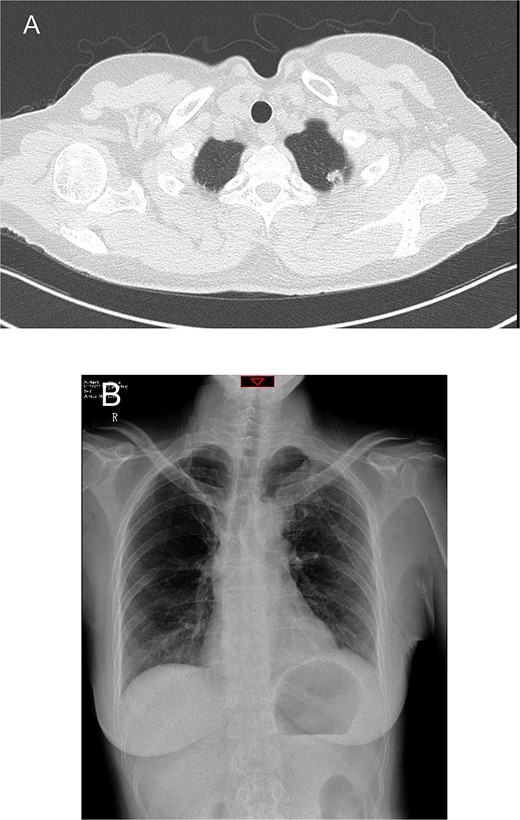 Preoperative chest computed tomography and postoperative day one chest X-ray. (A) Computed tomography shows a solid nodule in the S1+2 segment of the left upper lobe measuring 11 mm × 8 mm. (B) Postoperative day one chest X-ray indicates routine postoperative changes.