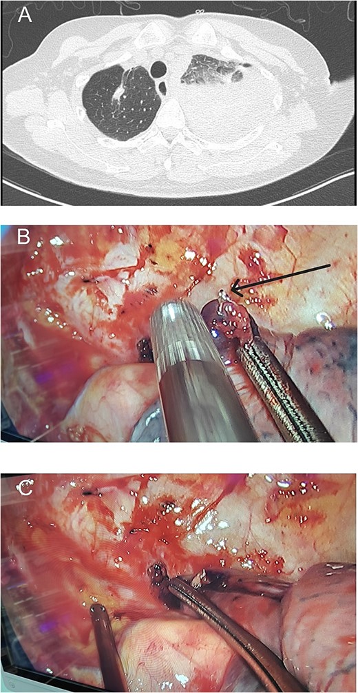 Preoperative chest computed tomography and intraoperative findings on postoperative day 3. (A) Computed tomography shows a large amount of fluid in the left pleural cavity, indicative of postoperative hemorrhage. (B) A protruding staple (black arrow) is observed at the resection margin of the left upper lung, near the site of chest wall bleeding. (C) During surgery, we attempted to reproduce the position that caused the bleeding.