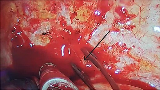 After clearing the blood clots, we observed a small artery on the surface of the posterior chest wall, around the second intercostal space, that was continuously bleeding in a jet-like manner (black arrow).