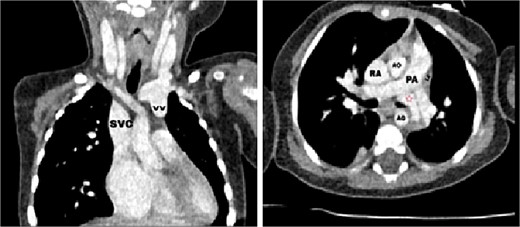 Axial (right) and coronal (left) postcontrast computed tomography sections: SVC: superior vena cava, VV: vertical vein, RA: right atrium, LA: left atrium, AO: aorta, PA: pulmonary artery, red star: The confluence of PVs.