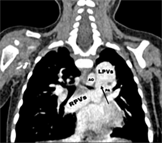 CT scan showing the right pulmonary veins (RPVs) and left pulmonary veins (LPVs) join all together posterior to the left atrium (LA) and pulmonary artery (PA), also showing the stenosis within the venous confluence between the drain of the right pulmonary veins and the drain of the left pulmonary veins.