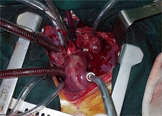 Operative image showing the vertical vein (VV) and pulmonary vein (PV).