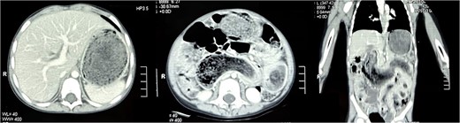 Transverse section of the CT scan of the abdomen revealing non-contrast enhancing, well-circumscribed homogenous mass in the stomach (left). Coronal section of the CT scan of the abdomen revealing the mass extending from the stomach all the way into jejunum (right).