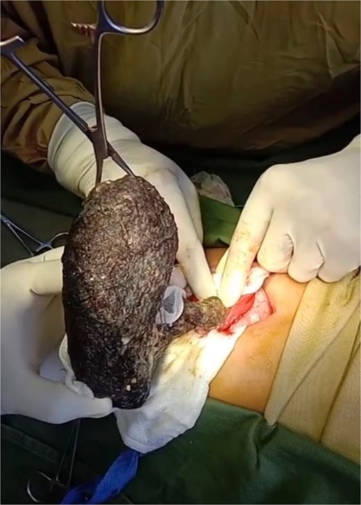 Trichobezoar being removed from the jejunum.