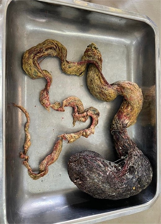 Gross specimen of the trichobezoar.