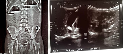 X-ray abdomen erect showing air fluid levels (left). Ultrasound abdomen showing intussusception (right).