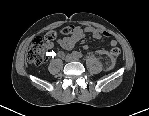 CT AP (axial) showing the lesion (arrow).