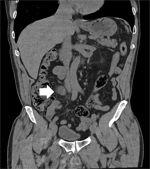 CT AP (coronal) showing the lesion (arrow).