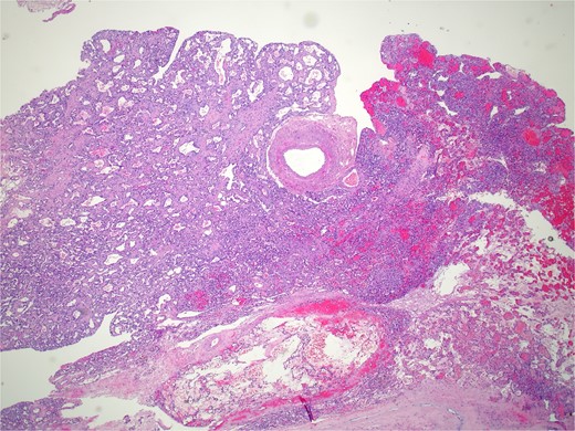 Histopathology micro findings showing anastomosing proliferation of capillary-sized vessels with mild endothelial cell nuclear variability.