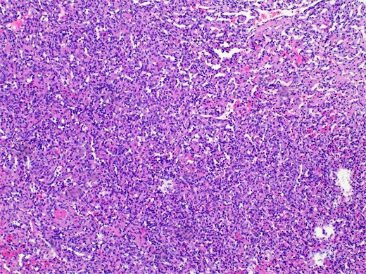 Histopathology micro findings showing scattered “hobnail” cells.