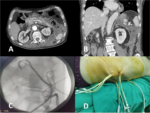 CT image of large infected peripancreatic collections with multiple air locules (A and B) and placed pigtail catheters post-imaging (C and D).