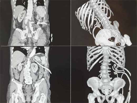 Abdominopelvic CT seven days after PCD.