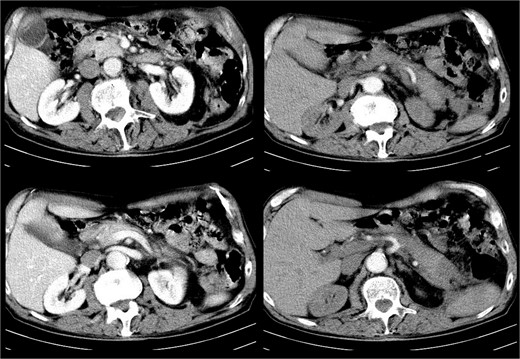 CT after one month showing no residual collections.
