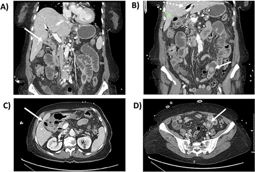 CT scan from the initial episode of gallstone ileus. A) Coronal CT: cholecystoduodenal fistula, B) Coronal CT: pneumobilia (superior, white dotted arrow) and air-filled gallbladder (inferior, green dotted arrow), impacted gallstone (solid white arrow), C) Axial CT: cholecystoduodenal fistula, D) Axial CT: impacted gallstone.