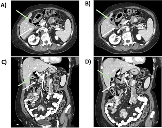 CT scan from follow-up after the index procedure. A) Axial CT: cholecystoduodenal fistula; air-filled gallbladder (superior, green arrow), duodenum (inferior, white arrow), B) Axial CT: air-filled gallbladder (superior, green arrow), duodenum (inferior, white arrow), C) Coronal CT: cholecystoduodenal fistula; air-filled gallbladder (superior,green arrow), duodenum (inferior, white arrow), D) Coronal CT: air-filled gallbladder (superior, green arrow), duodenum (inferior, white arrow).