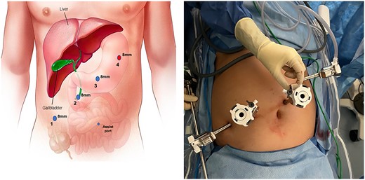 Trocar placement. Veress entry was performed at Palmer's point. Three additional 8-mm ports were placed approximately 6-cm equidistant as shown. The Veress entry site is increased in size to accommodate the #4 8-mm trocar. Instrumentation is as follows: 1) fenestrated bipolar 2) robotic camera 3) interchangeable port (monopolar scissor, robotic suction, prograsp) 4) tip-up with 4x4 inserted to elevate the liver 5) 5 mm assist port if needed.
