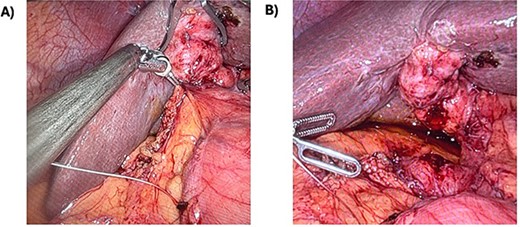 Cholecystoduodenal fistula. A) This is the cholecystoduodenal fistula prior to division. B) After division, there was a 1-cm duodenotomy.