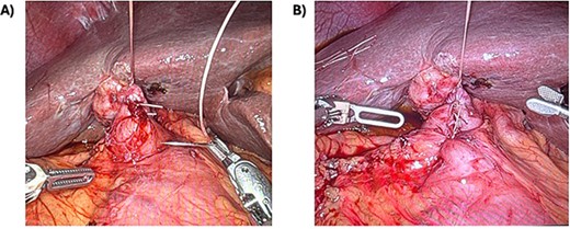 Primary repair of duodenotomy. A) Using a stay suture, additional interrupted sutures were performed. B) Here is a view of the completed sutured repair with the stay suture still in-place.