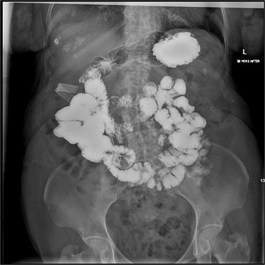Postoperative upper gastrointestinal study. The postoperative upper gastrointestinal study showed flow through the duodenum without contrast leakage.