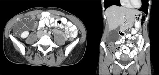 CT showing cystic structure abutting the right kidney, liver, and gallbladder.