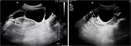 Ultrasound imaging revealing a multiseptated cystic mass measuring 4.4 × 7.7 × 9.3 cm, suspicious for exophytic complex hepatic cyst.