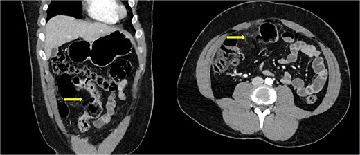 Abdominal computed tomography of coronal and axial cuts showing bowel perforation (arrow).