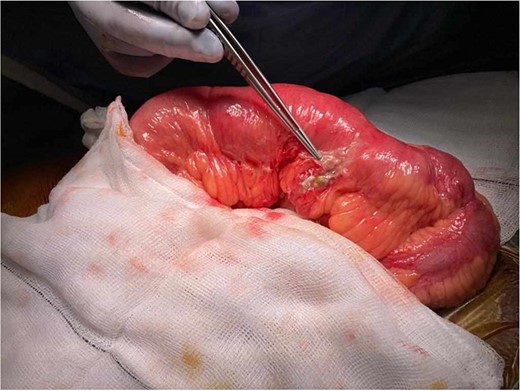 Photographic imaging showing the site of perforation in the small bowel.