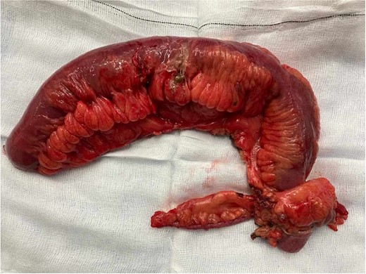 Photographic imaging of resected bowel.