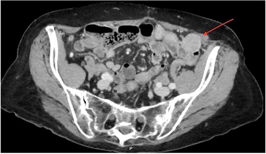 CT imaging of the pelvis (axial section) displaying a rounded 2.7 × 2.7 cm heterogeneous mass localized in the left anterior pelvic cavity, near the colon wall, without peripheral enhancement.