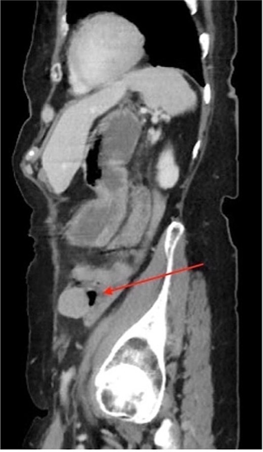 CT imaging of the pelvis (sagittal section) displaying the left localization of the 2.7 × 2.7 cm heterogeneous pelvic mass.