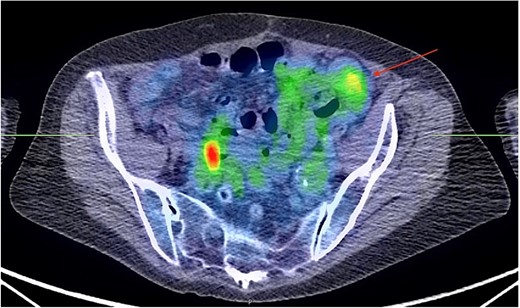 PET scan showing a rounded nodule within the anterior mesentery in the left pelvis measuring 2.6 × 2.6 cm in size. It has a moderate tracer uptake with peak SUV of 3.6. (arrow). No other mesenteric nodules are identified. The image visualized on the right pelvis was considered a normal physiologic uptake within the bowel.