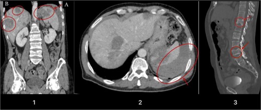 Illustrates a contrast-enhanced image obtained during the portal venous phase CT scan. Noteworthy findings include a hypodense lesion in the upper pole of the spleen (Image 1A), multiple liver lesions (Image 1B), evidence of a capsular laceration with adjacent free fluid indicative of intraperitoneal hemorrhage (Image 2), and compression fractures noticed on the vertebral body of T12 and L4 due to metastasis (Image 3).