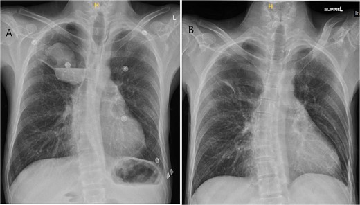 Chest X-ray imaging of incidentally found right new apical lung mass (A). This lesion was absent in the patient’s X-ray taken 5 months prior (B).