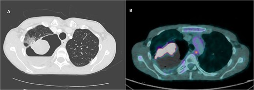 CT imaging of right intracavitary lung mass found within the wall of a longstanding bulla, along with heterogeneous fluid layering within the cavity (A). The mass was reported to be 4.4 × 5.2 cm and was concerning for primary bronchogenic malignancy. This lesion increased to 6.8 × 5.9 cm, demonstrating intense increased FDG activity and interval increase in fluid layering within the bulla within 2 months on follow-up PET imaging (B).