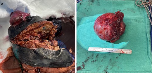 En bloc wedge resection of the right upper and lower lobe (A). The right upper lobe mass was a well-encapsulated tumor and measured 10.8 × 9.8 × 7.7 cm (B).