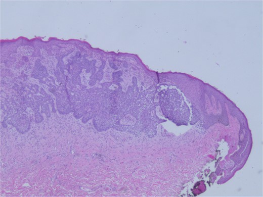 Microphotograph revealing basal cell carcinoma component on histology.