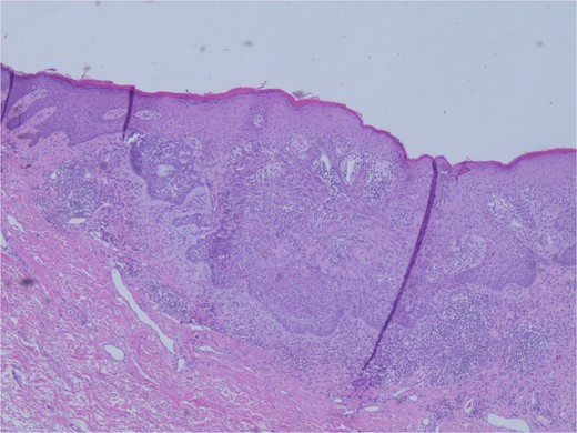Microphotograph revealing BSC with abnormal squamous keratinization on histology.