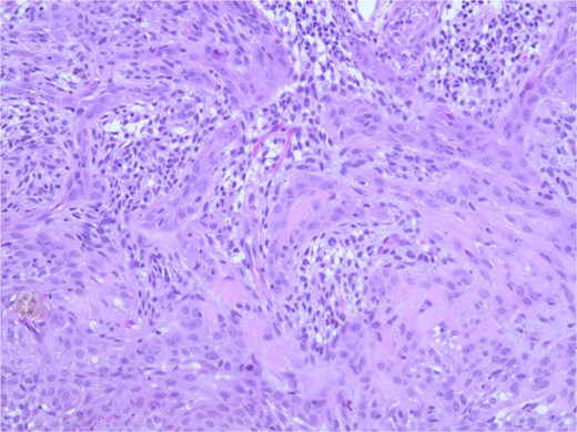 Microphotograph revealing BSC with abnormal squamous keratinization on histology.