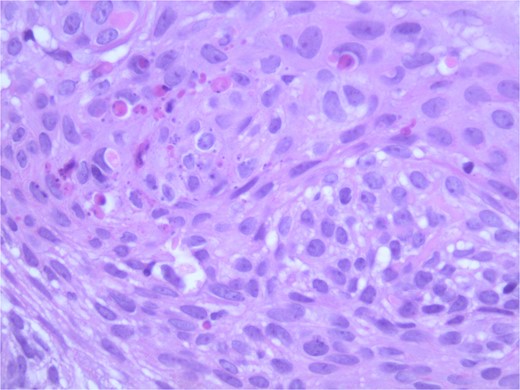 Microphotograph revealing BSC with abnormal squamous keratinization on histology.