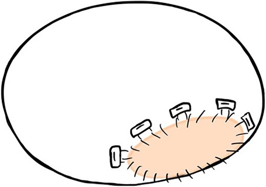 The 2 × 4-cm pericardial patch is seen to cover the P2 site of the annulus from the inside during the first operation.