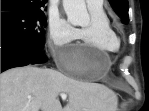 Computed tomography scan at 2 months after left ventricular rupture repair. There is a huge pseudoaneurysm (110 × 57 mm) on the posterior side of the left ventricle.