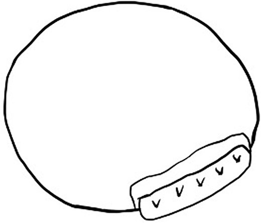 The two pericardial patches are used to close a 5-mm rupture hole under the posterior mitral annulus.
