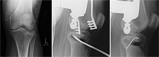 Fracture reduction, articular reduction, posterior slope restoration, and temporary fixation with K-wire.