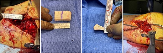 Tricortical iliac crest allograft preparation, measurement, cut to an appropriate size, and insertion into the defect.