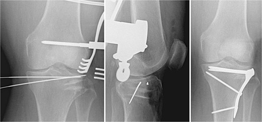Fracture fixation using 3.5 mm LCP proximal tibia plate, rafting screws, and tricortical iliac crest allograft holding the articular surface.