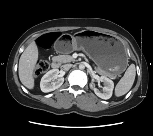 Abdominal CT with IV contrast showing fluid distension of the stomach and duodenal bulb with encirclement of pancreatic tissue around the first portion of the duodenum.