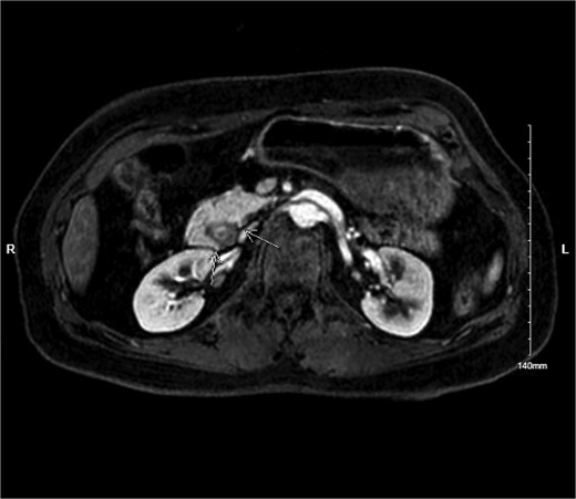 MRI MRCP showing annular pancreas causing near complete obstruction of the second portion of the duodenum.