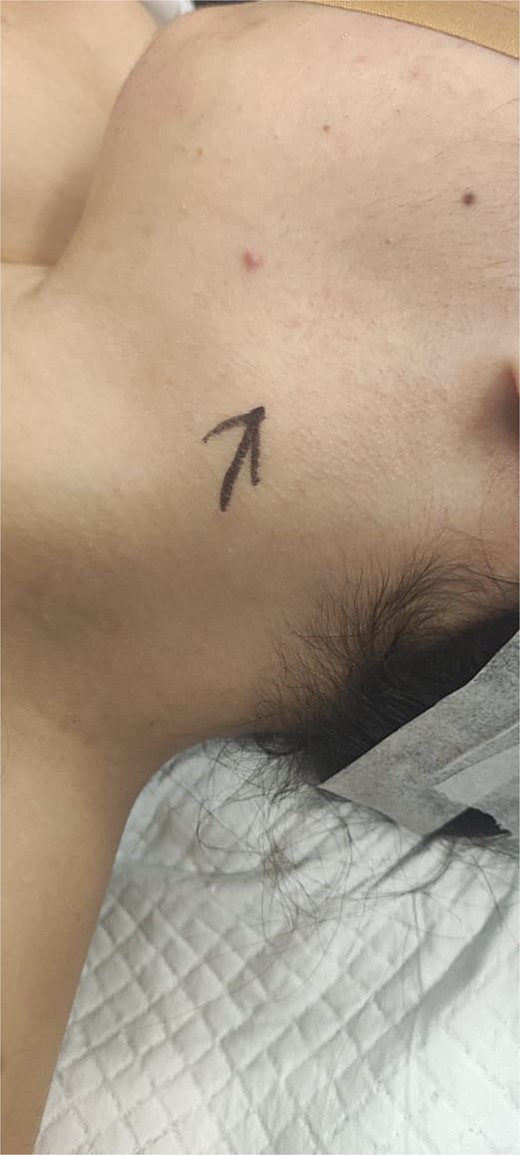 Gross photograph of the patient’s neck. Black drawn arrow points to the branchial cleft cyst.