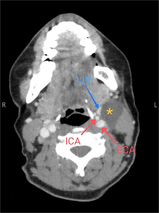 Axial CT neck scan showing the branchial cleft cyst compressing the IJV and adjacent to the external and internal jugular arteries. Asterisk: branchial cleft cyst, arrows: external and internal carotid arteries, blue arrow: IJV.