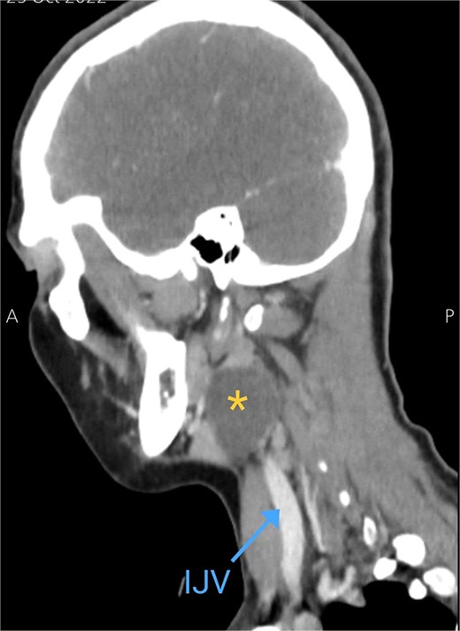 Sagittal CT neck scan showing the branchial cleft cyst. Asterisk: branchial cleft cyst, blue arrow: IJV.